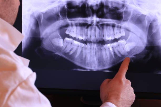 Best Emergency Tooth Extraction in Carpentersvle, IL